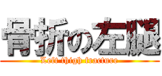 骨折の左腿 (Left thigh fracture)